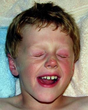 Незнакомые факты об аллергии на пыль